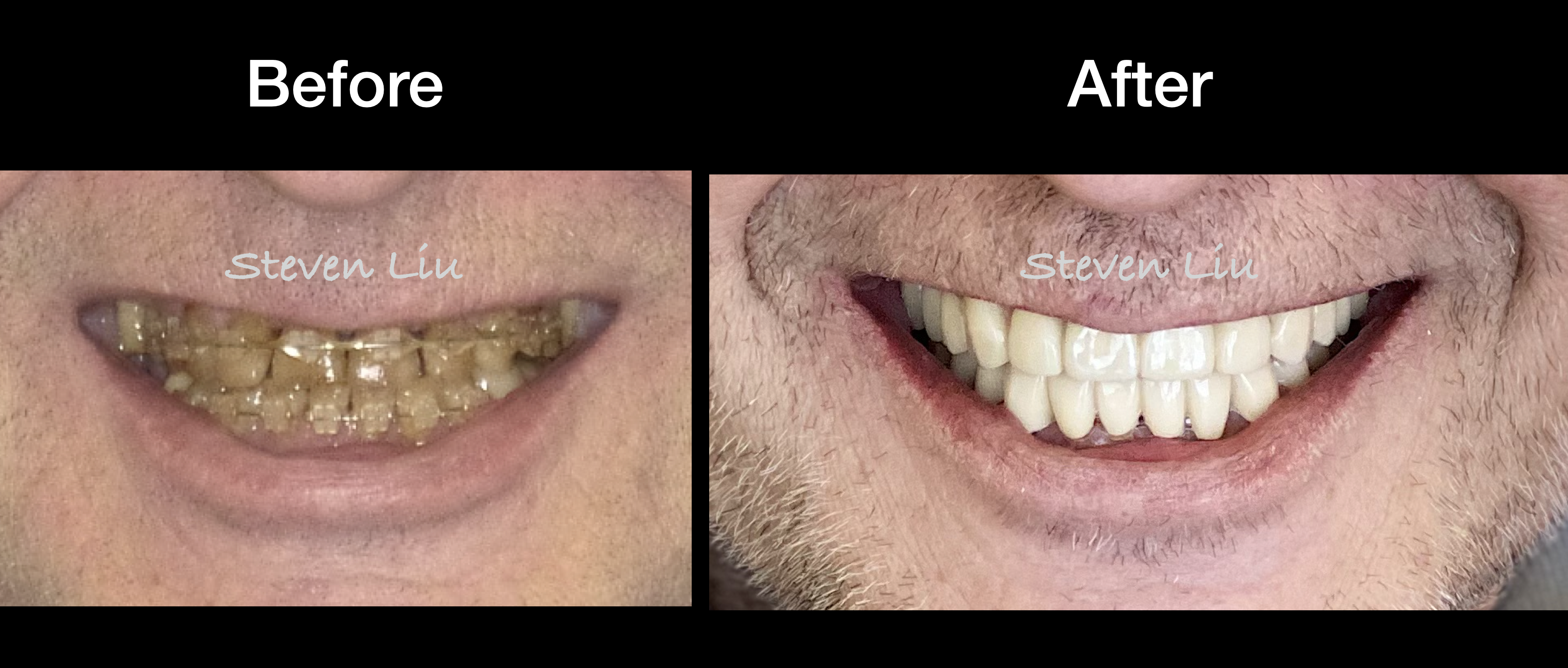 Orthodontic Therapy and Full Mouth Reconstruction